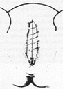 Infibulazione