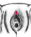 Circoncisione femminile